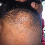 Xavier Woods Reveals He Underwent Surgery: “The Lymphoma That Was Carved Out Of The Back Of My Head”