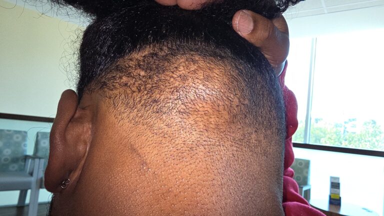 Xavier Woods Reveals He Underwent Surgery: “The Lymphoma That Was Carved Out Of The Back Of My Head”