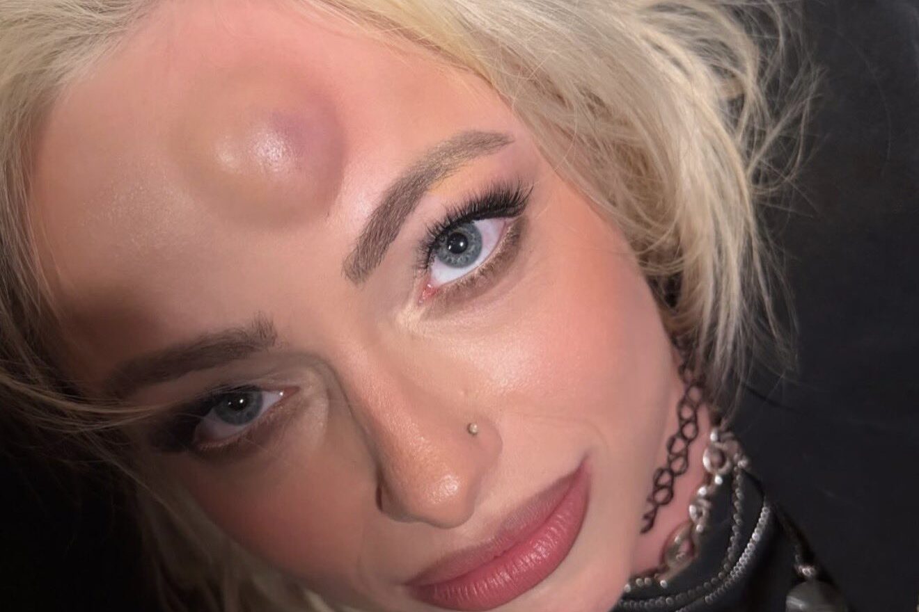 Liv Morgan Shows Off Large Hematoma From Clash Of Heads With Roxanne Perez On WWE RAW